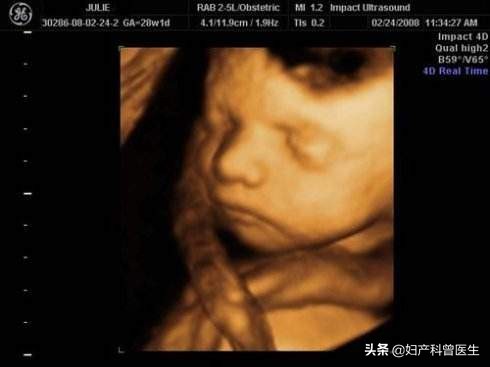 妈妈看场电影，胎儿竟然在宫内拳打脚踢，一检查发现脐带绕颈两周