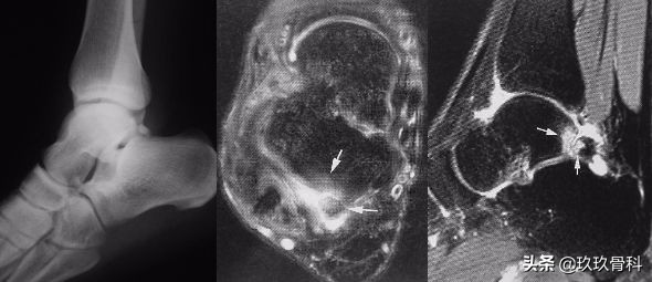 陈旧性踝关节损伤的治疗,踝关节损伤现场处理视频