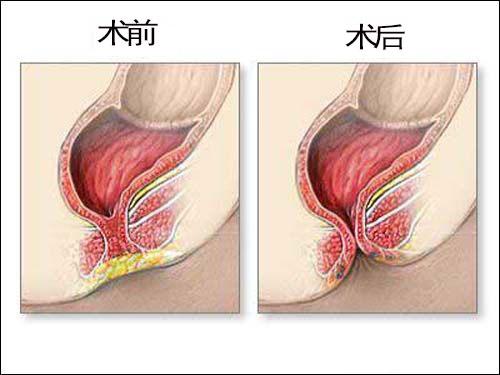 “无肛儿”，真是被诅咒的？