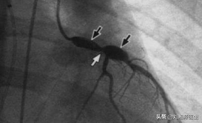 「免疫相关不良妊娠答疑解惑40」——系统性血管炎