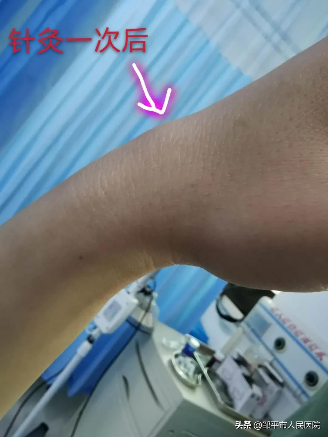 针灸三次就有效果还需要再扎吗,针灸治疗皮下囊肿