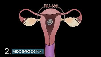 那些避孕失败的女孩,后来怎样了?