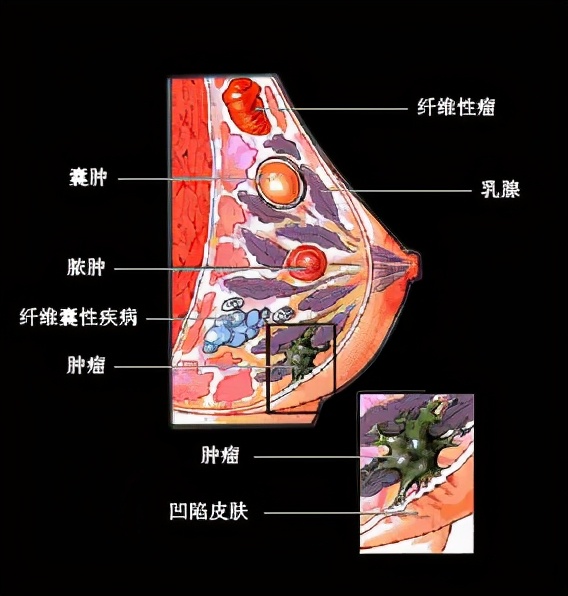 45岁女性乳腺结节,35岁以上女性出现的乳腺结节
