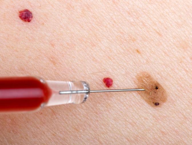 怎么判断痣是癌变还是普通痣,皮肤上长红痣要当心是肝病的征兆