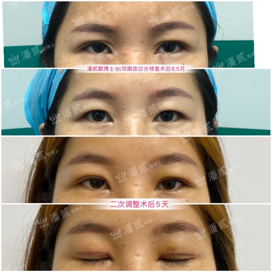 双眼皮太深显老怎么修复,双眼皮失败后修窄