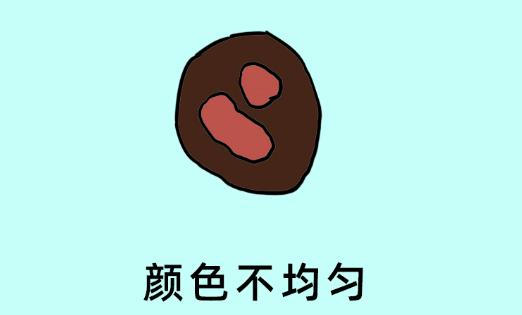 科普一颗平淡无奇的痣竟然会癌变,痣癌变的信号有哪些