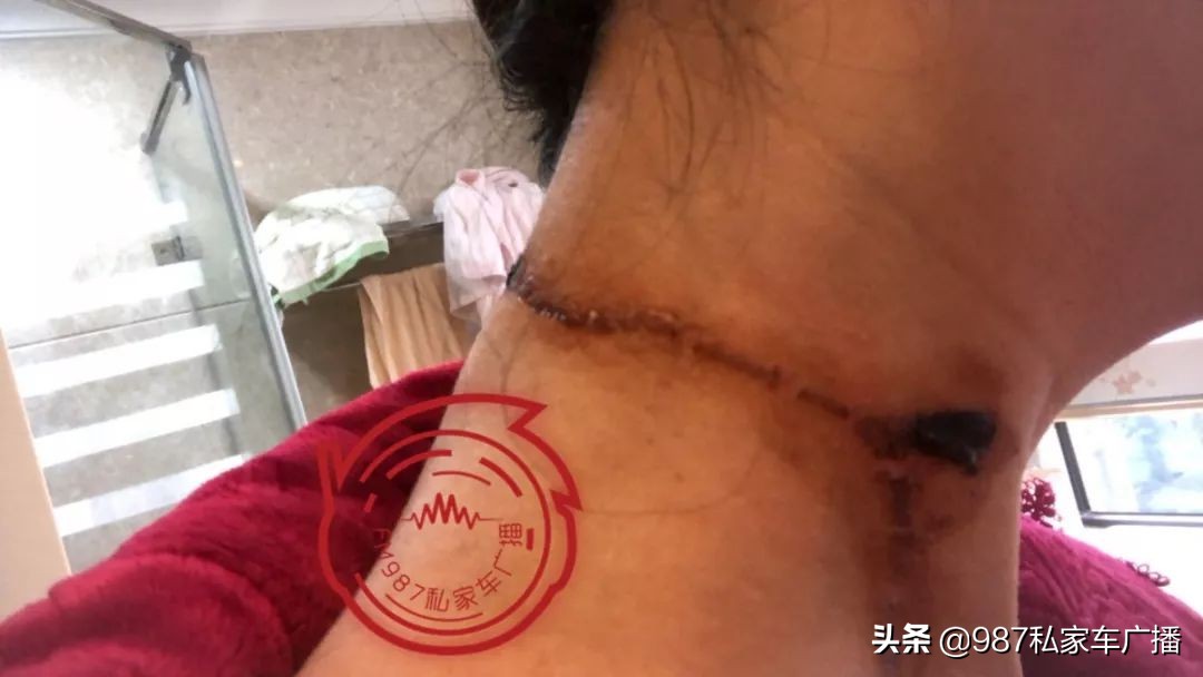福州一女子进店美发,竟遭滚烫蒸汽喷射……疤痕吓人!