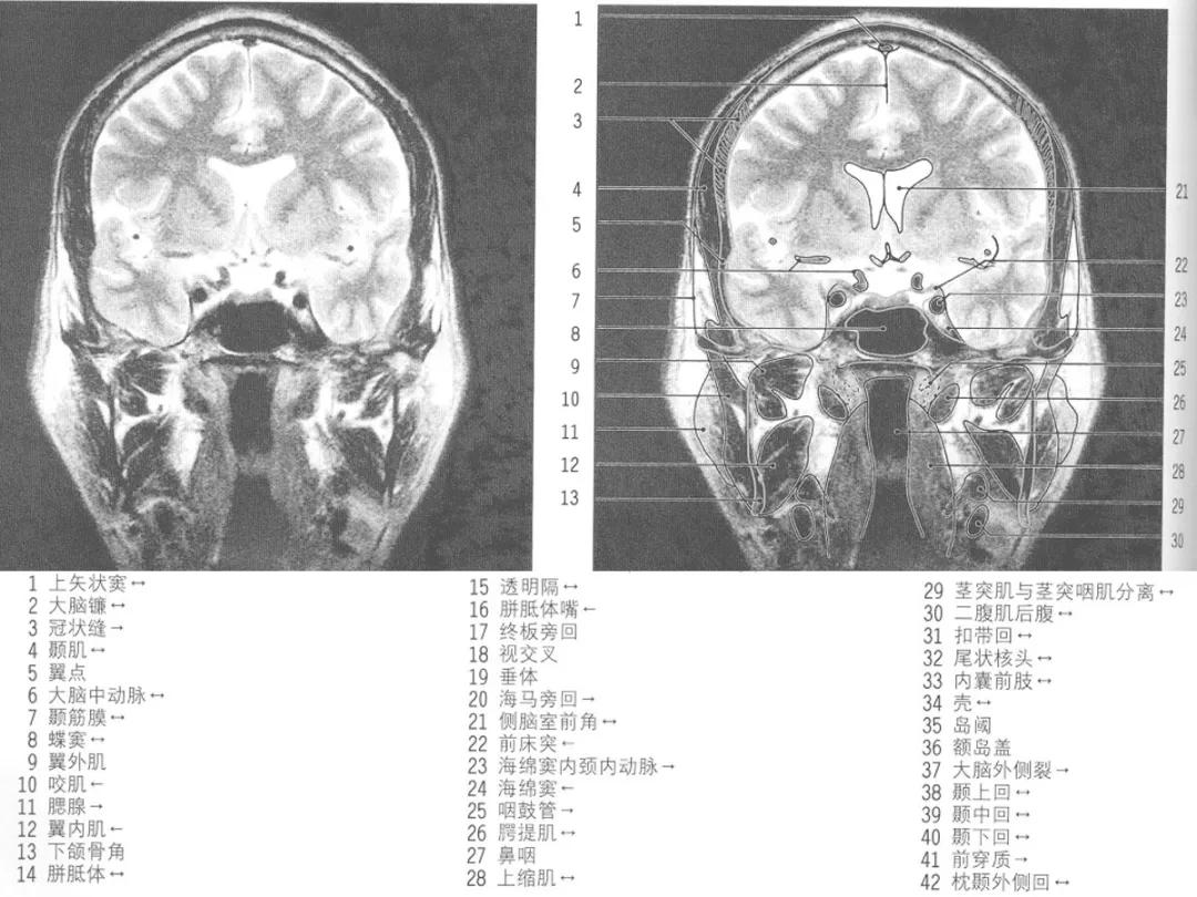 颅脑冠状状切面解剖图,颅脑mr解剖结构图