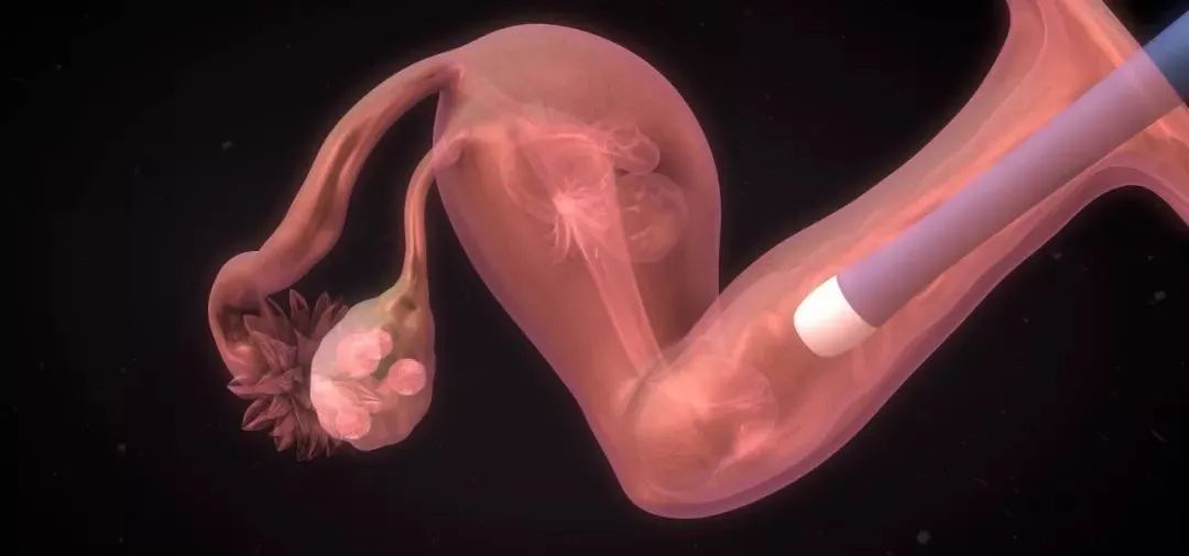 宫腔粘连手术过后第二次月经变少,月经量少和流产刮宫有关系吗