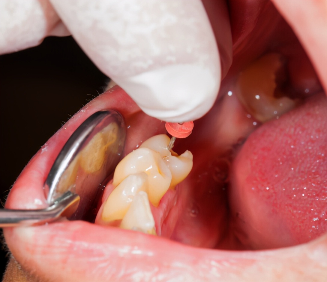 做根管治疗封药以后出血正常吗,根管治疗后牙齿出血