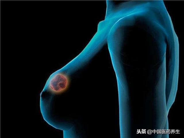 专治乳腺癌验方用药剂量,乳腺癌中药方子30多味药靠谱吗