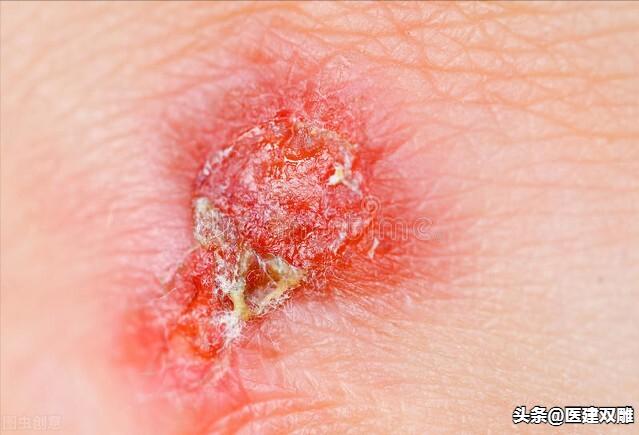 炉甘石洗剂男性慎用,炉甘石洗剂的妙用