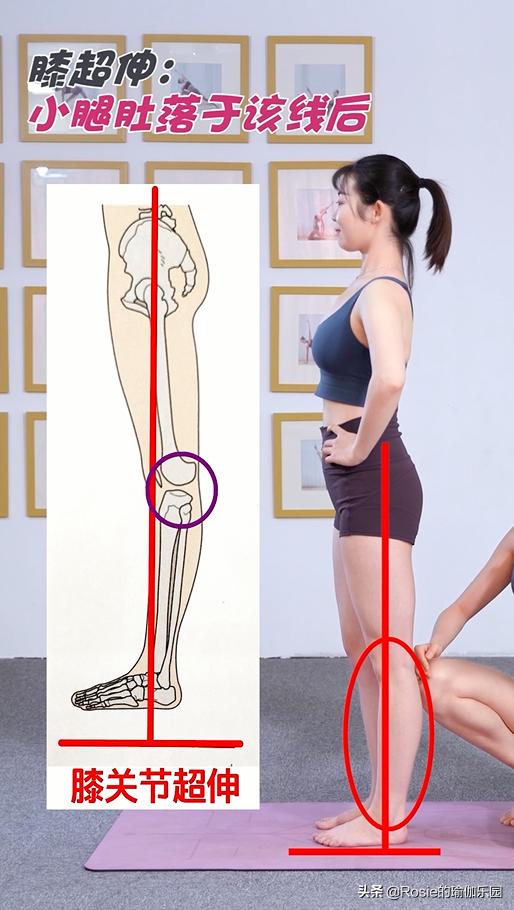 锻炼小腿内侧肌肉改善O型腿,小腿粗大腿壮如何变细腿