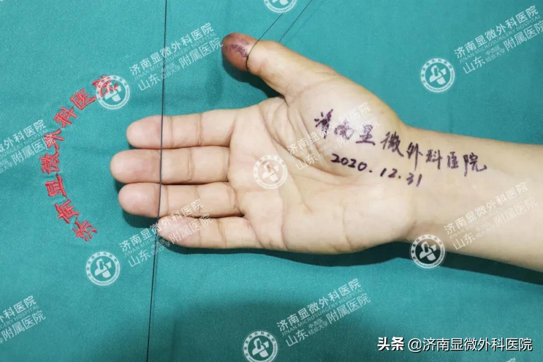 手指少了一块肉怎么处理,手指少了一截