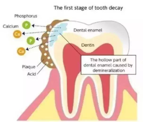 防止牙菌斑正确刷牙方法,清除牙菌斑的刷牙方法