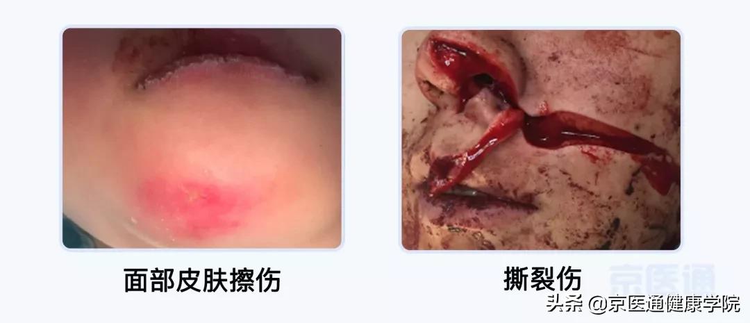 运动前怎么预防损伤,运动之前涂什么预防受伤