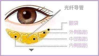 这些年我们踩过的护肤坑,目前最靠谱的去眼袋方法