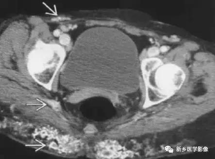 左肾可见高密度影不是结石,结节状高密度影是结石吗