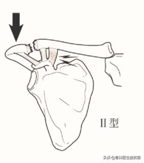 武磊左肩骨错位韧带撕裂,武磊首次回应左肩伤势