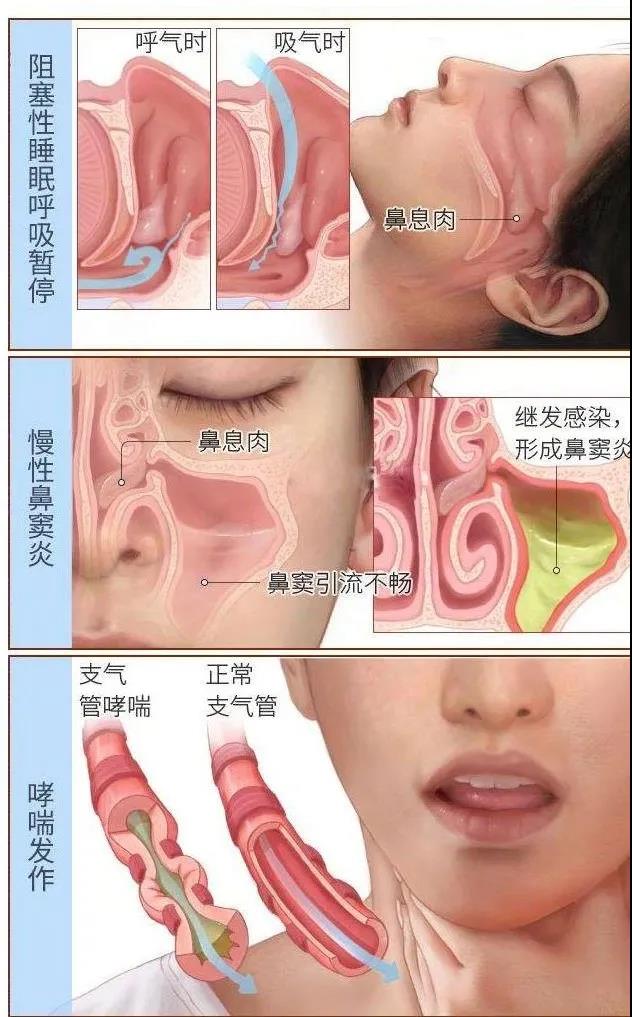 鼻息肉引起的鼻塞和嗅觉减退,感冒会引起鼻息肉鼻塞吗