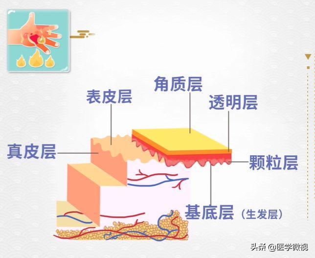 被烫伤大面积疤痕是怎么样的,被烫伤最有效的急救方法是什么