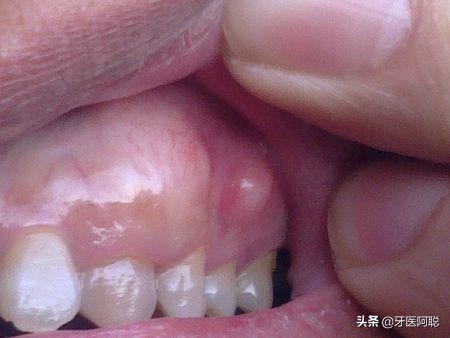 牙骨突出嘴也凸怎么办,牙槽不平怎么办