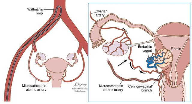 卵巢癌晚期中药治疗成功案例,奥拉帕利治疗卵巢癌晚期效果好吗