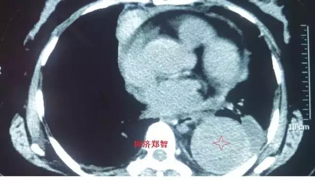 磁共振可以替代cta检查主动脉夹层,超声心动图联合cta诊断主动脉夹层