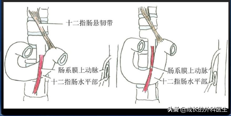 肠系膜上动脉压迫综合征ct表现,儿童肠系膜压迫综合征哪种手术好