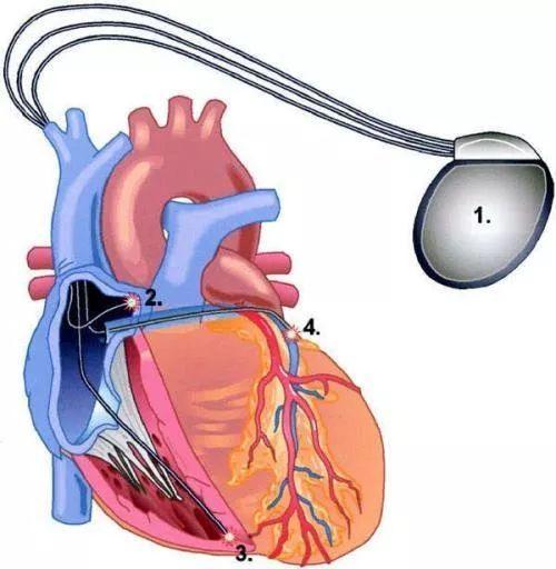 慢性肺源性心脏病是外科还是内科,检查心脏瓣膜病去内科还是外科