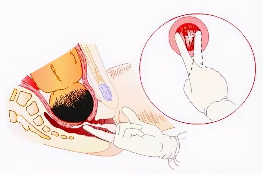 女性顺产开十指,开十指一定能顺产下去吗