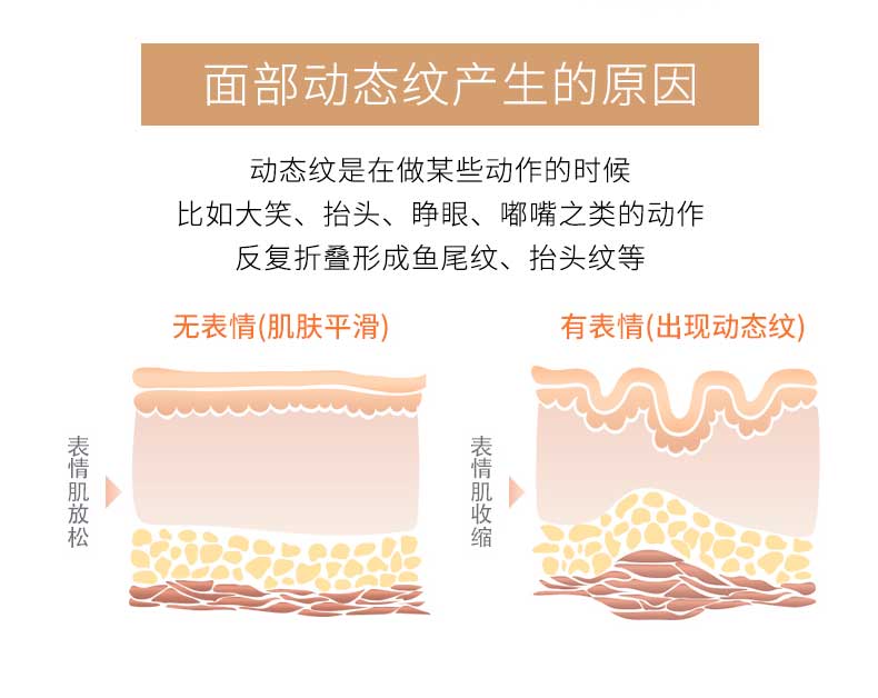 动态皱纹和静态皱纹的区别,静态皱纹和动态皱纹哪个更显老