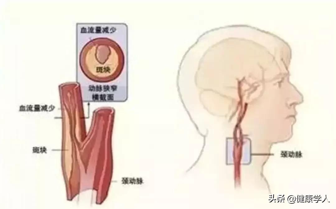 让人闻风丧胆的“脑梗死”究竟是怎么回事？