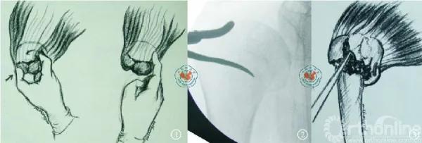 肱骨近端骨折内固定手术的经验与教训