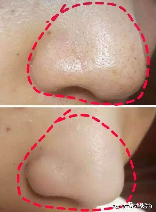 目前市面上最有效的去黑头,目前市面上最好用的去黑头方法