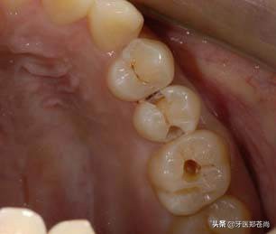 蛀牙根管治疗可以打麻醉吗,蛀牙根管治疗全过程多少钱