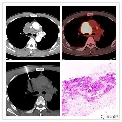 肺神经内分泌癌早期手术好吗,肺部神经内分泌肿瘤治疗