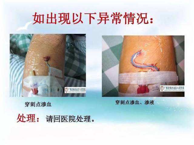不可不知道的PICC置管后的居家护理