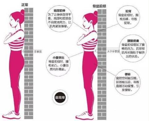 什么是骨盆前倾和后倾图片,男性骨盆前倾是什么样的