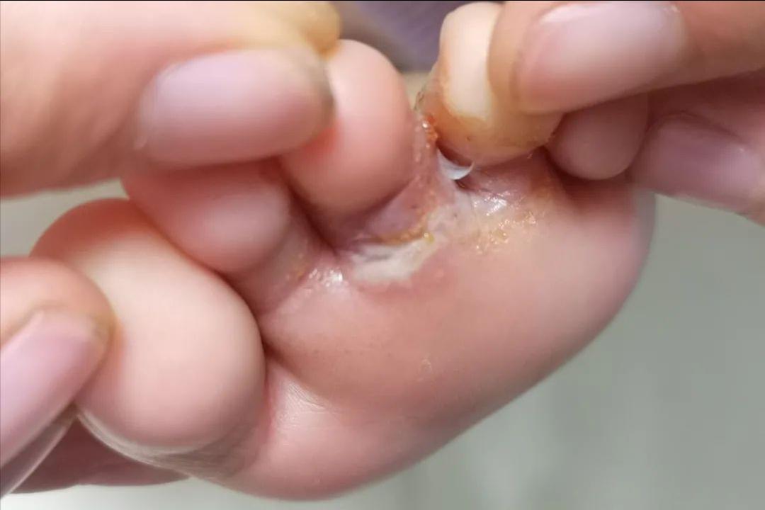 你以为的脚气还不是脚气