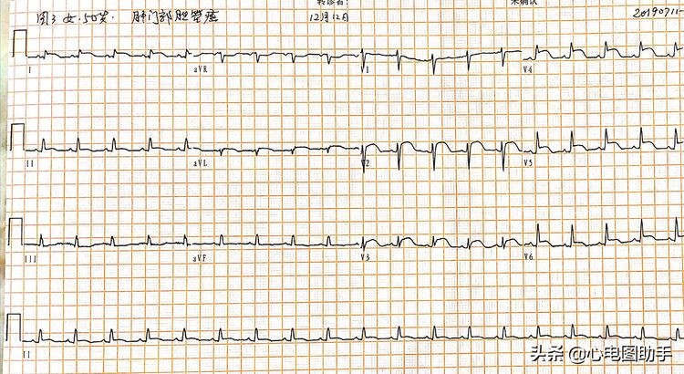 心脏肿瘤转移了还能手术吗,心脏肿瘤转移到肺