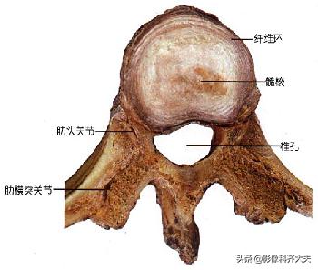腰椎间盘突出最好的影像诊断方法,腰椎间盘突出的影像学检查