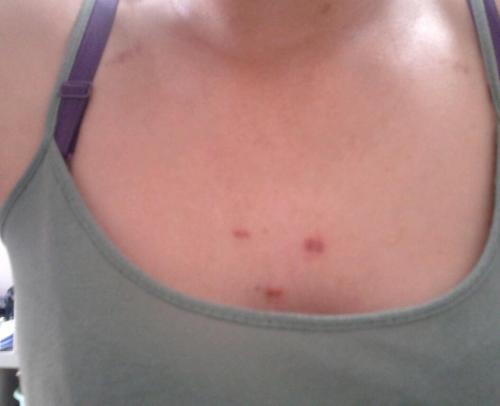 为什么胸前长的痘痘都变成疤痕痘,为什么胸前长很多痘