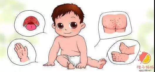 怎么预防手足口病最简单的方法,手足口病怎么预防幼儿园