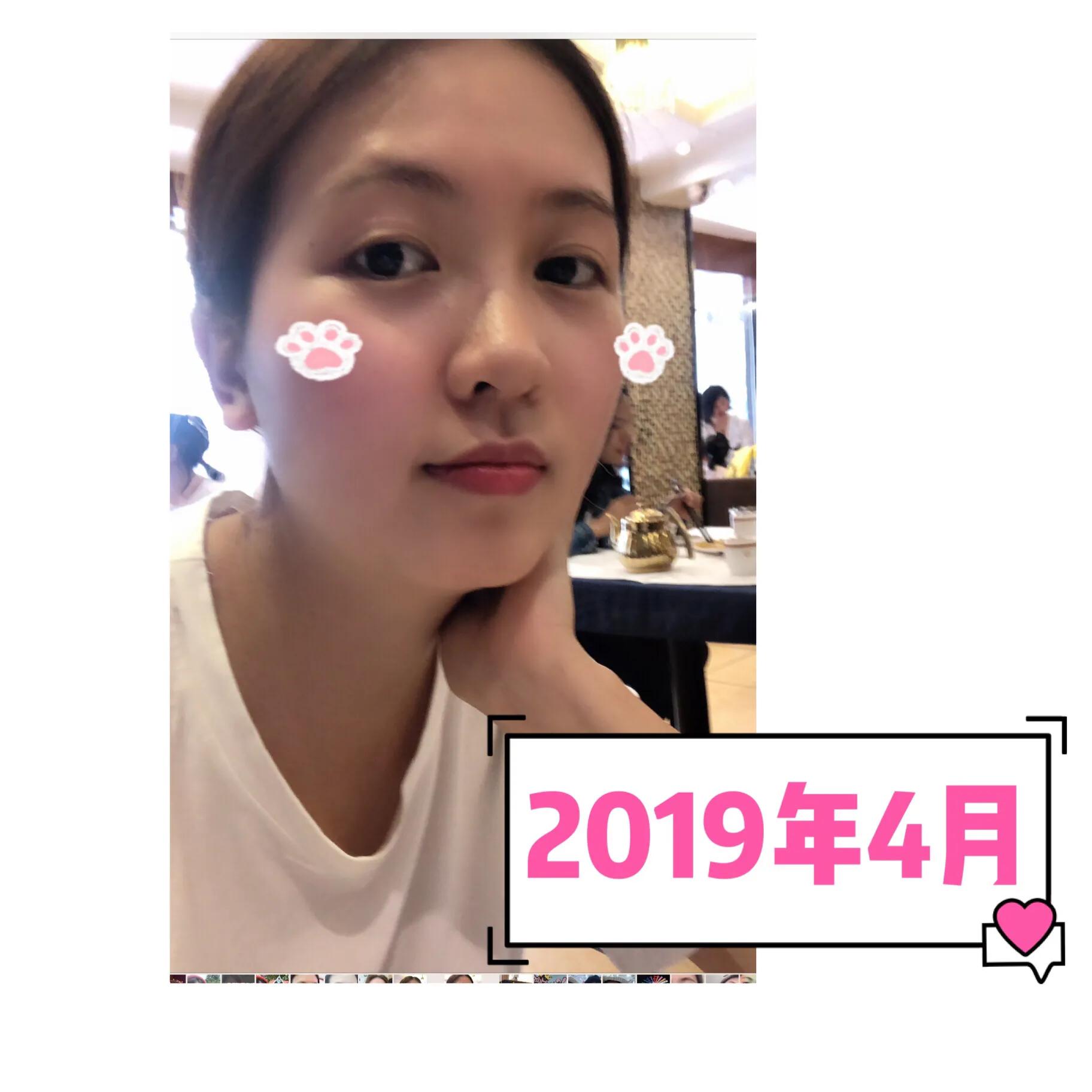 与病魔对抗的第30天,激素脸排毒第31天