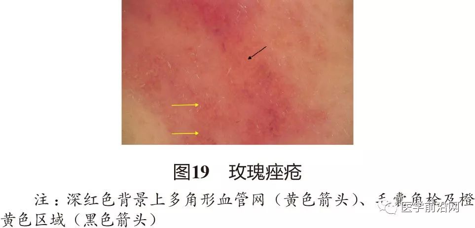 面部常见皮肤病皮肤镜诊断专家共识全文发布