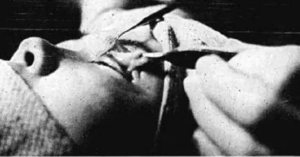 双眼皮真的有那么漂亮吗,自然双眼皮和割的双眼皮内在区别