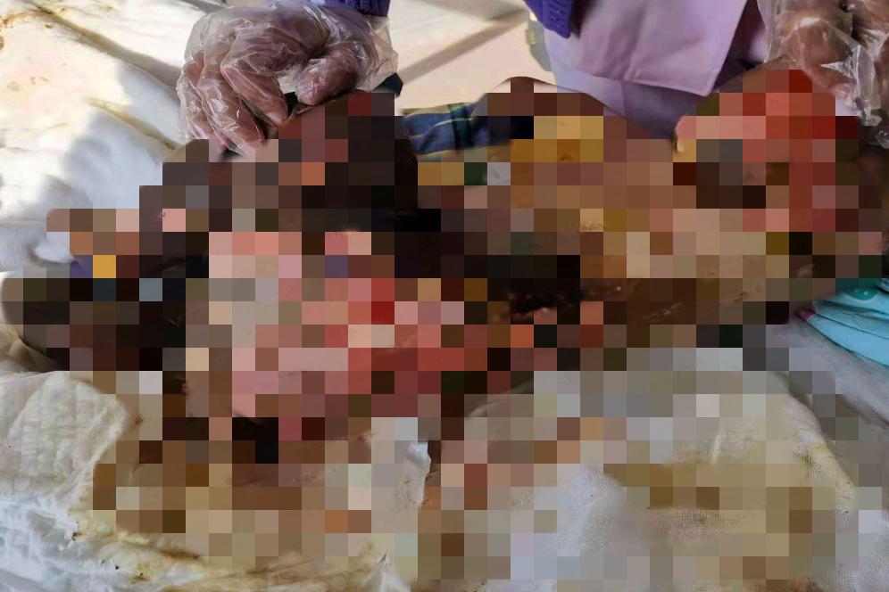 小女孩儿烧伤植皮,烧伤女婴被遗弃后续