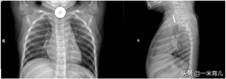 儿童消化道异物处理,小孩吃了耳环塞异物怎么办