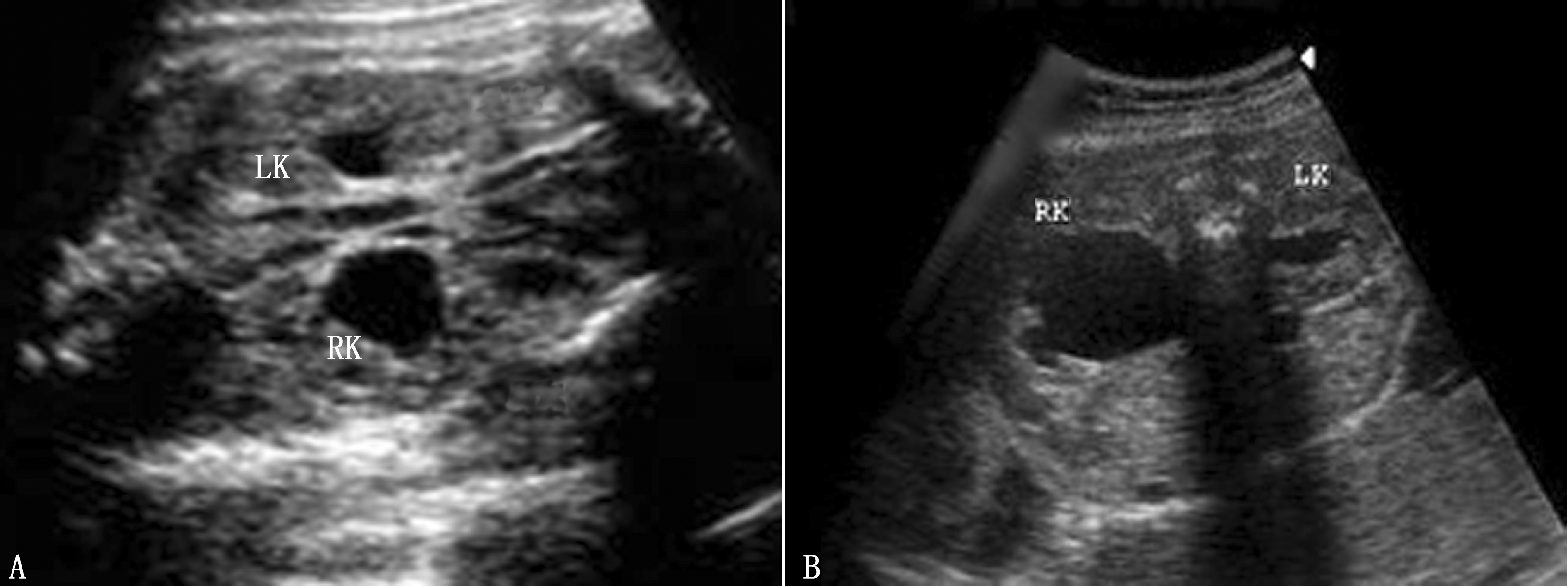 泌尿彩超全过程3d,胎儿肾积水要不要看泌尿科